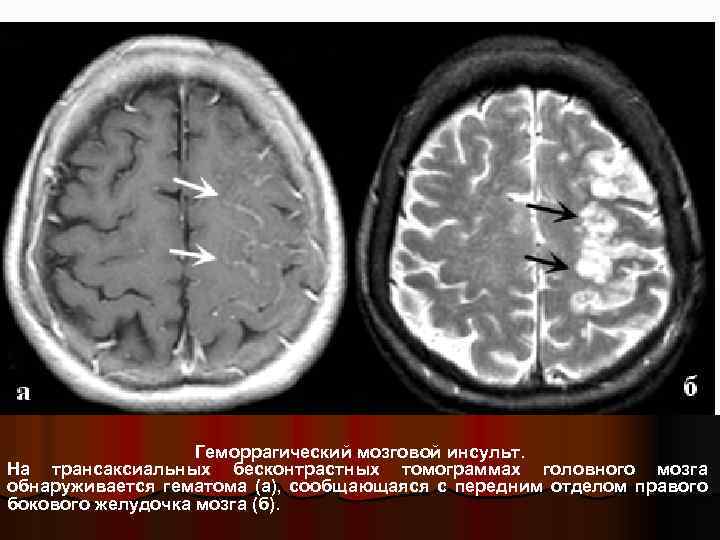 Геморрагический мозговой инсульт. На трансаксиальных бесконтрастных томограммах головного мозга обнаруживается гематома (а), сообщающаяся с