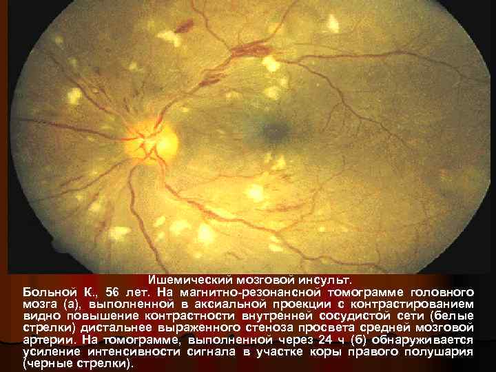 Ишемический мозговой инсульт. Больной К. , 56 лет. На магнитно-резонансной томограмме головного мозга (а),