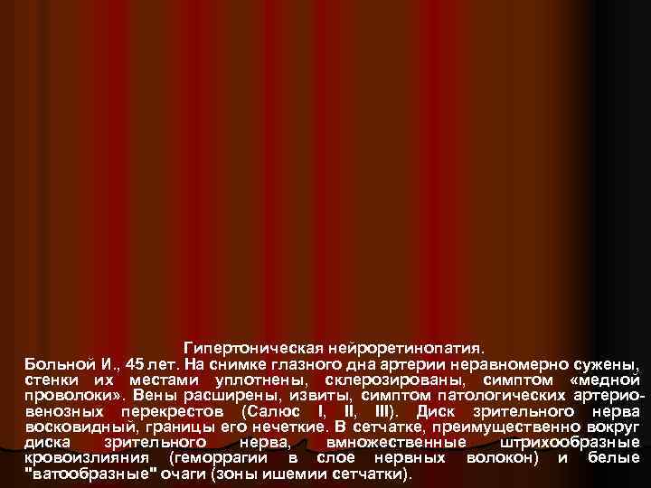 Гипертоническая нейроретинопатия. Больной И. , 45 лет. На снимке глазного дна артерии неравномерно сужены,