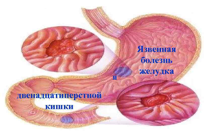 и двенадцатиперстной кишки Язвенная болезнь желудка Язвенная