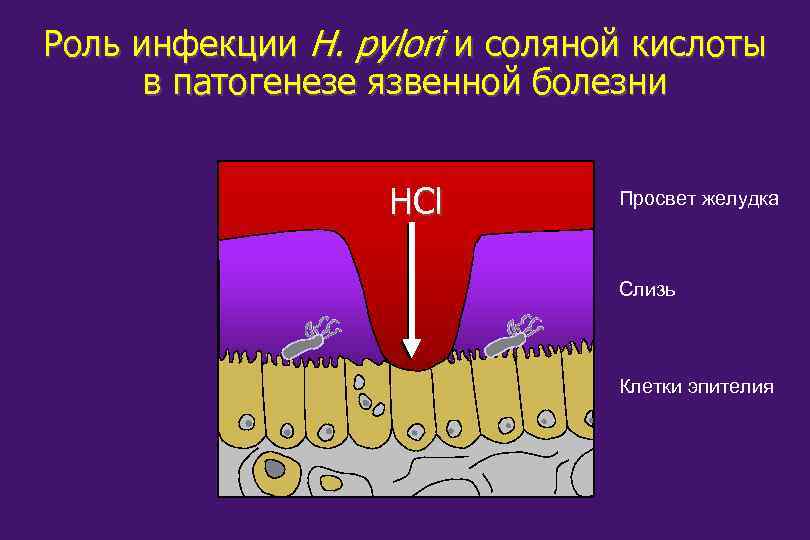 Роль инфекции H. pylori и соляной кислоты в патогенезе язвенной болезни HCl Просвет желудка