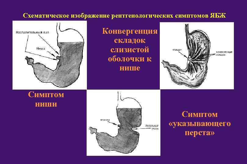 Схематическое изображение рентгенологических симптомов ЯБЖ Конвергенция складок слизистой оболочки к нише Симптом ниши Симптом