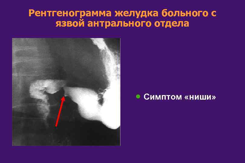 Рентгенограмма желудка больного с язвой антрального отдела · Симптом «ниши» 