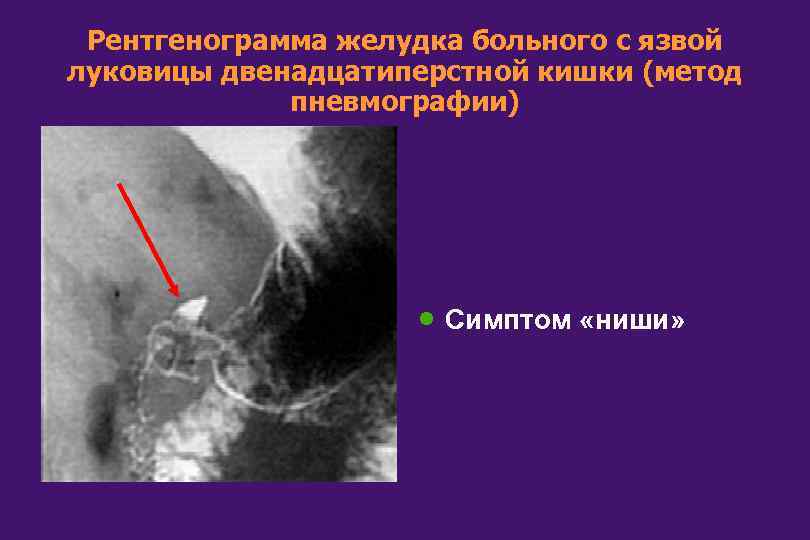 Рентгенограмма желудка больного с язвой луковицы двенадцатиперстной кишки (метод пневмографии) · Симптом «ниши» 