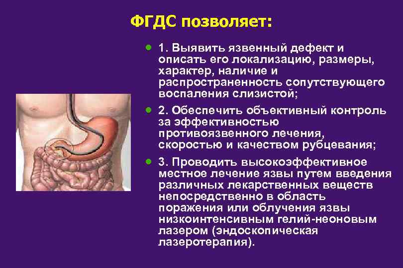 ФГДС позволяет: · · · 1. Выявить язвенный дефект и описать его локализацию, размеры,