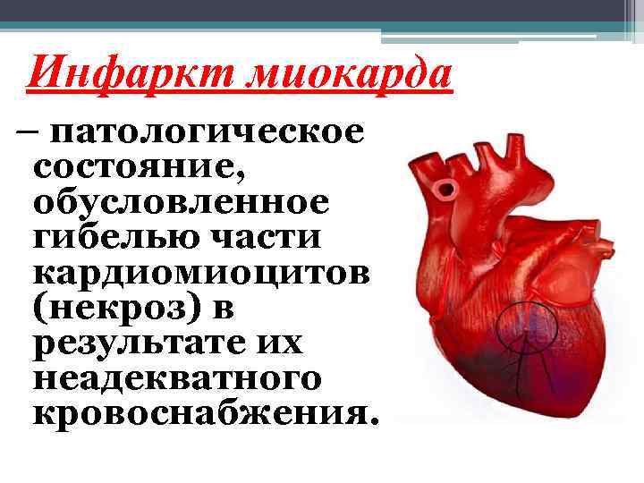 Инфаркт миокарда – патологическое состояние, обусловленное гибелью части кардиомиоцитов (некроз) в результате их неадекватного