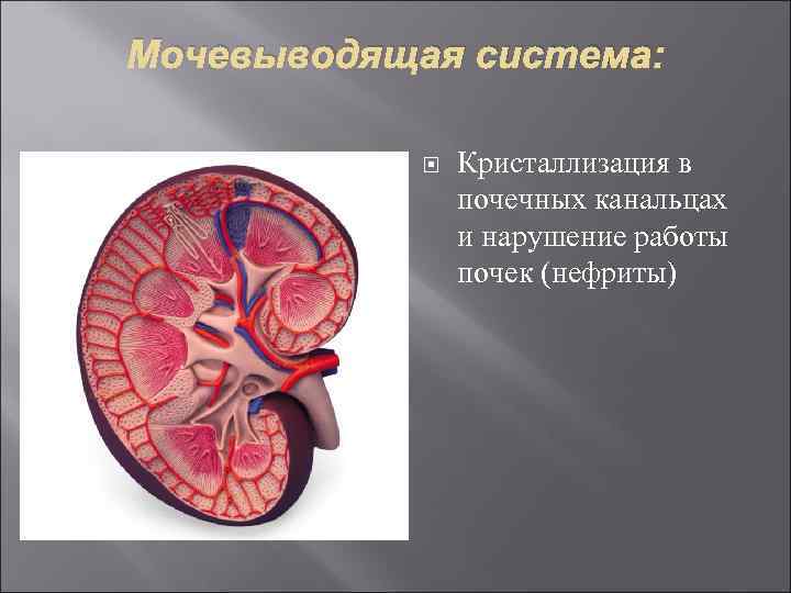 Мочевыводящая система: Кристаллизация в почечных канальцах и нарушение работы почек (нефриты) 