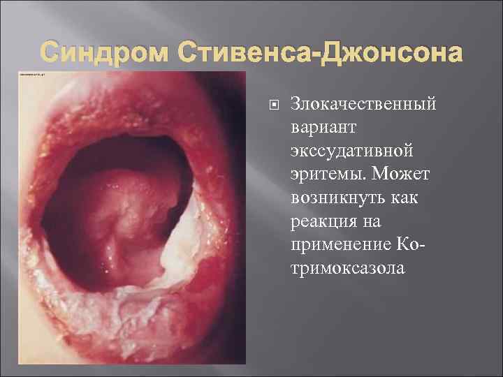 Синдром Стивенса-Джонсона Злокачественный вариант экссудативной эритемы. Может возникнуть как реакция на применение Ко тримоксазола