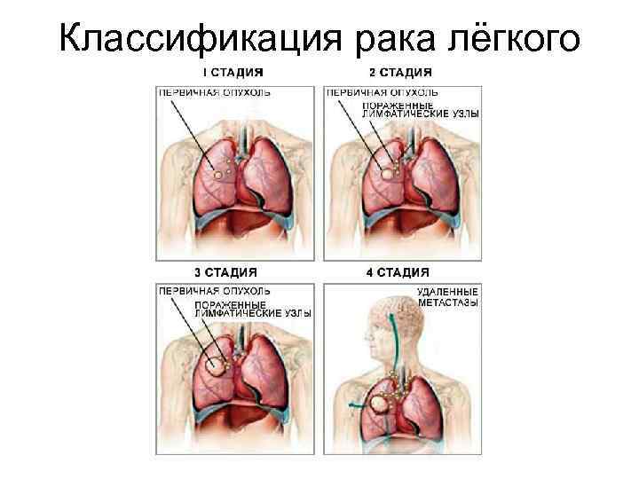 Классификация рака лёгкого по стадиям 