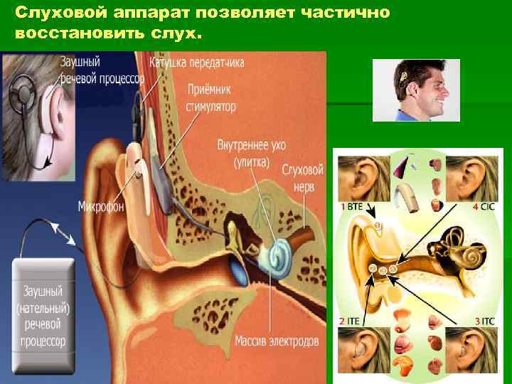 Слуховой аппарат позволяет частично восстановить слух. 