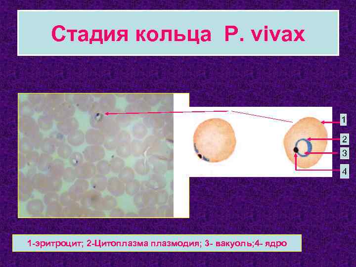 Стадия кольца P. vivax 1 2 3 4 1 -эритроцит; 2 -Цитоплазма плазмодия; 3