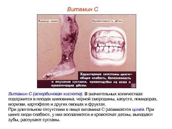 Витамин С (аскорбиновая кислота). В значительных количествах содержится в плодах шиповника, черной смородины, капусте,