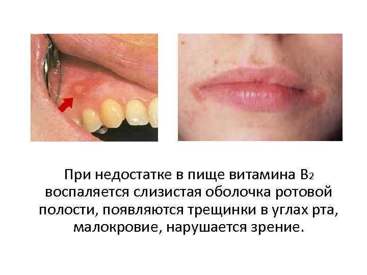 При недостатке в пище витамина В 2 воспаляется слизистая оболочка ротовой полости, появляются трещинки