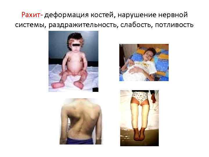 Рахит- деформация костей, нарушение нервной системы, раздражительность, слабость, потливость 