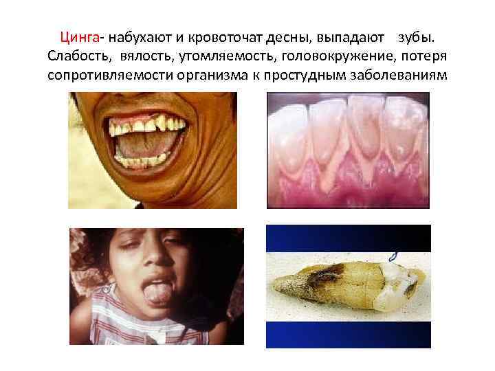 Цинга- набухают и кровоточат десны, выпадают зубы. Слабость, вялость, утомляемость, головокружение, потеря сопротивляемости организма