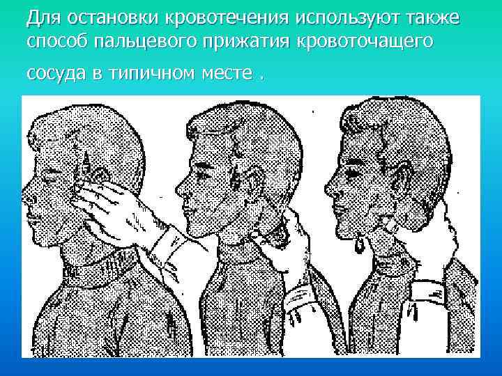 Для остановки кровотечения используют также способ пальцевого прижатия кровоточащего сосуда в типичном месте. 