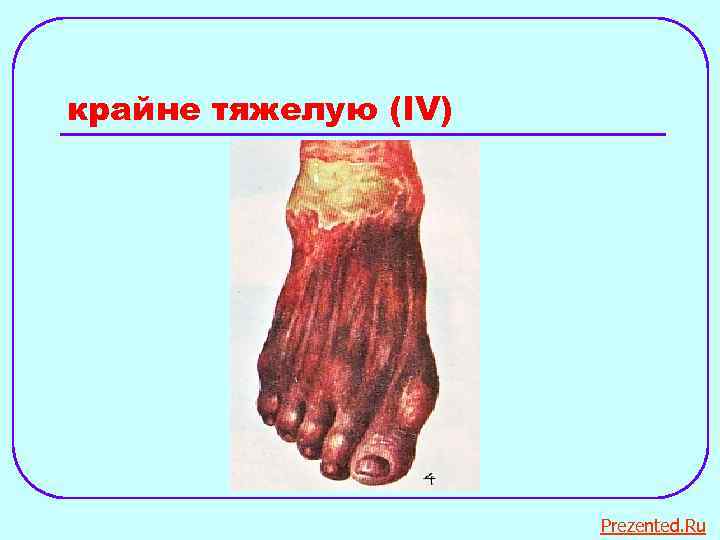 крайне тяжелую (IV) Prezented. Ru 