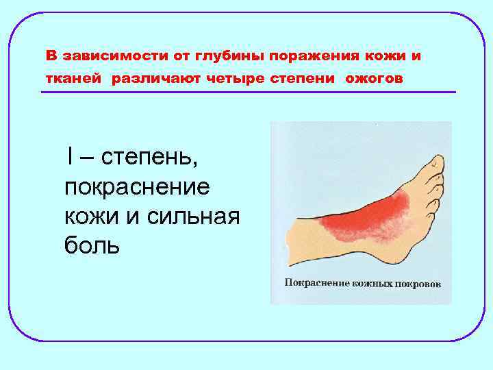 В зависимости от глубины поражения кожи и тканей различают четыре степени ожогов I –