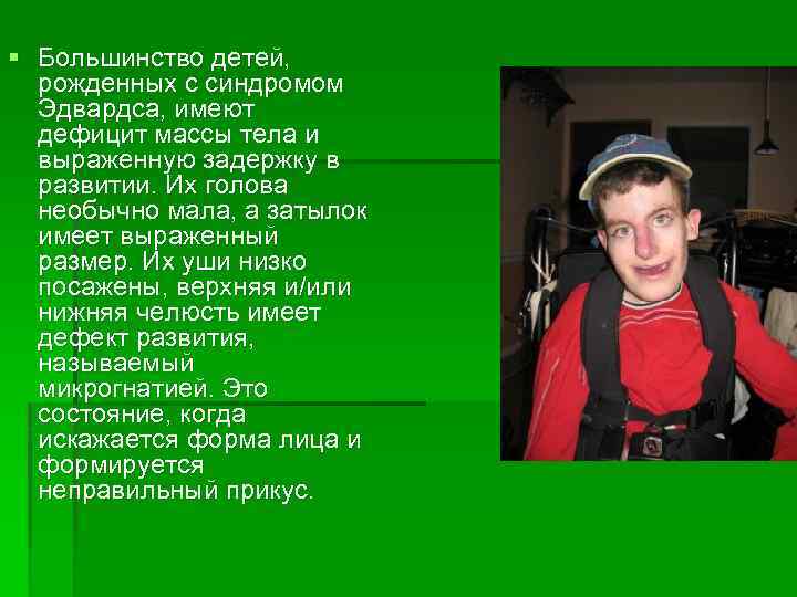 § Большинство детей, рожденных с синдромом Эдвардса, имеют дефицит массы тела и выраженную задержку