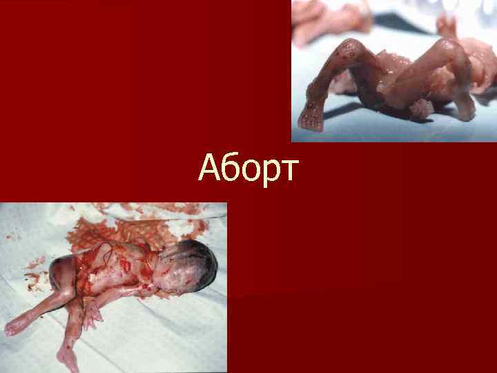 Аборт 