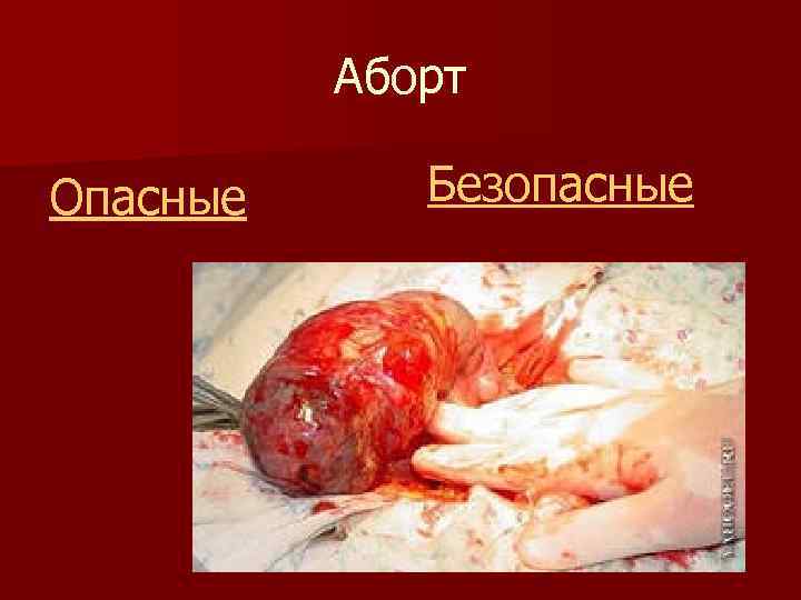 Аборт Опасные Безопасные 