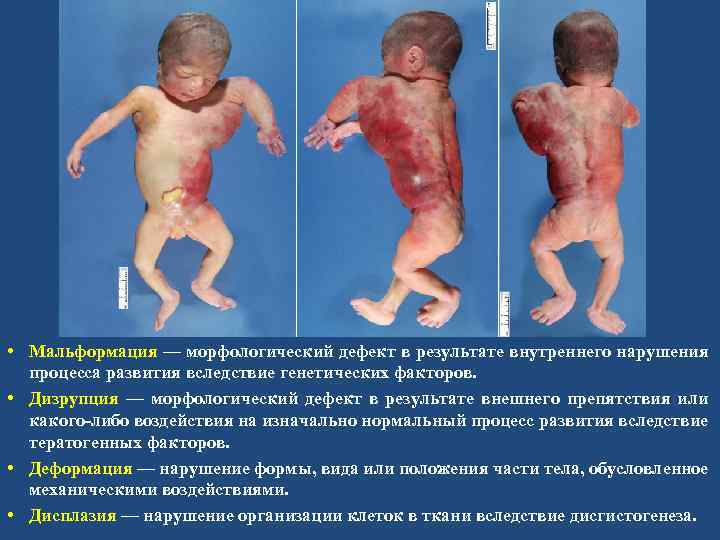  • Мальформация — морфологический дефект в результате внутреннего нарушения процесса развития вследствие генетических