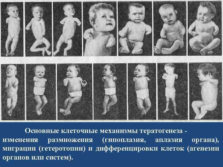 Основные клеточные механизмы тератогенеза изменения размножения (гипоплазия, аплазия органа), миграции (гетеротопии) и дифференцировки клеток
