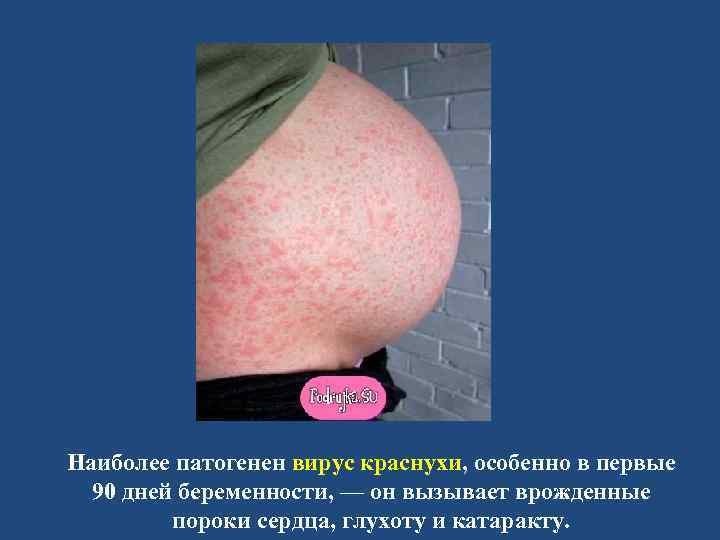 Наиболее патогенен вирус краснухи, особенно в первые 90 дней беременности, — он вызывает врожденные