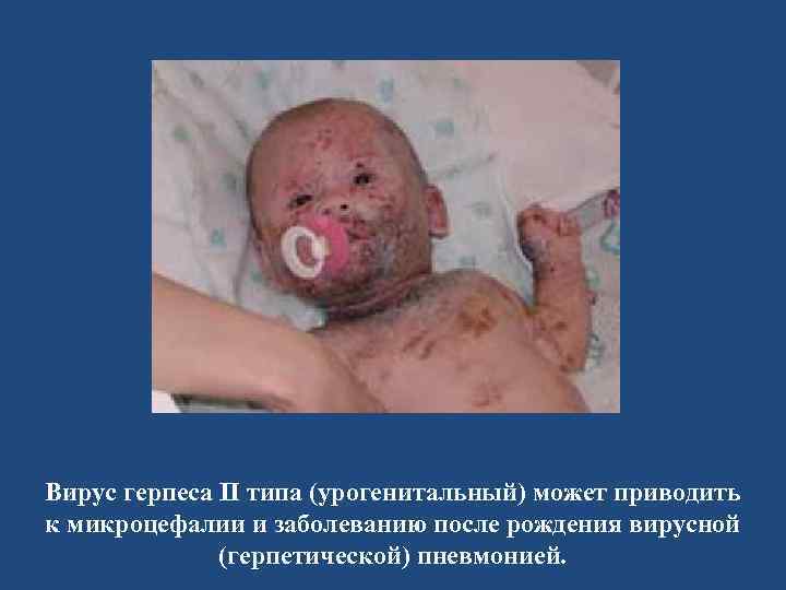 Вирус герпеса II типа (урогенитальный) может приводить к микроцефалии и заболеванию после рождения вирусной