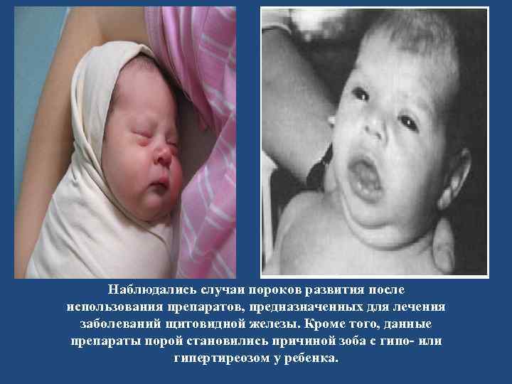 Наблюдались случаи пороков развития после использования препаратов, предназначенных для лечения заболеваний щитовидной железы. Кроме