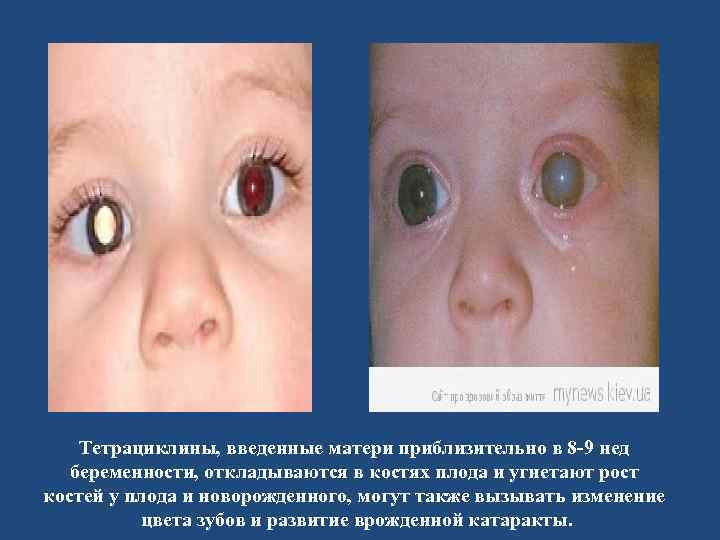 Тетрациклины, введенные матери приблизительно в 8 -9 нед беременности, откладываются в костях плода и