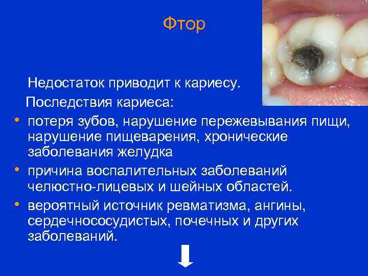 Фтор • • • Недостаток приводит к кариесу. Последствия кариеса: потеря зубов, нарушение пережевывания