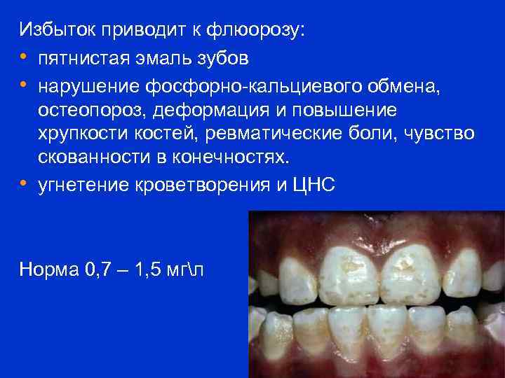 Избыток приводит к флюорозу: • пятнистая эмаль зубов • нарушение фосфорно-кальциевого обмена, остеопороз, деформация