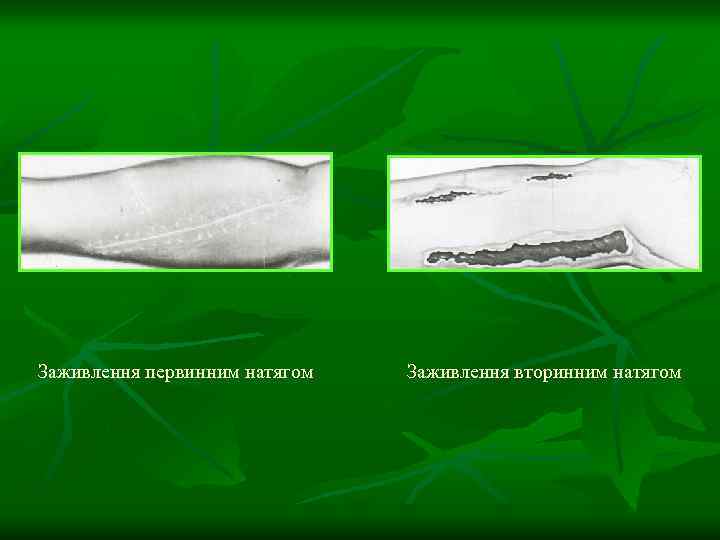 Заживлення первинним натягом Заживлення вторинним натягом 