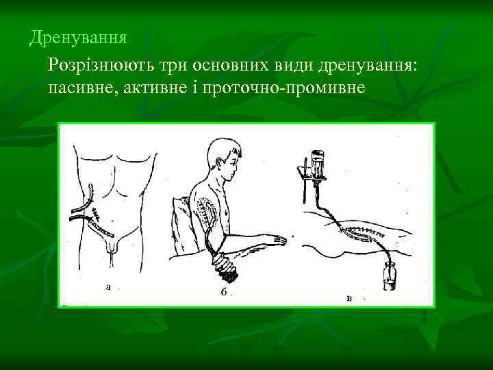 Дренування Розрізнюють три основних види дренування: пасивне, активне і проточно-промивне 