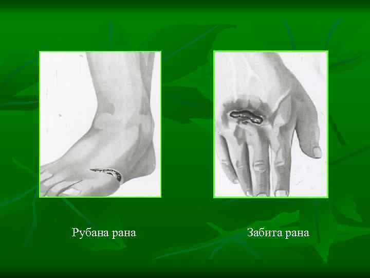 Рубана рана Забита рана 