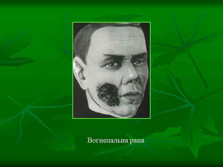 Вогнепальна рана 