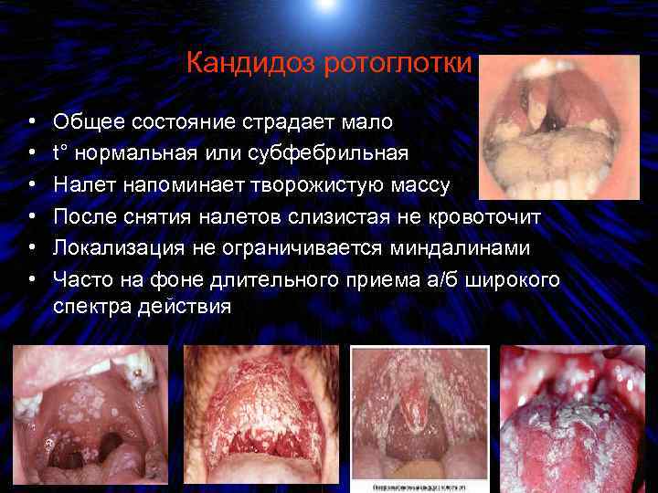 Кандидоз ротоглотки • • • Общее состояние страдает мало t° нормальная или субфебрильная Налет