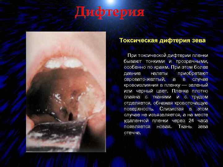 Дифтерия Токсическая дифтерия зева При токсической дифтерии пленки бывают тонкими и прозрачными, особенно по