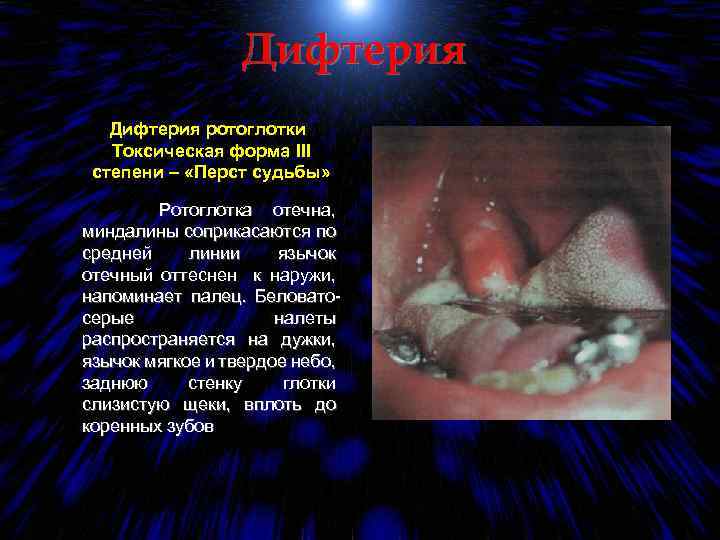 Дифтерия ротоглотки Токсическая форма III степени – «Перст судьбы» Ротоглотка отечна, миндалины соприкасаются по