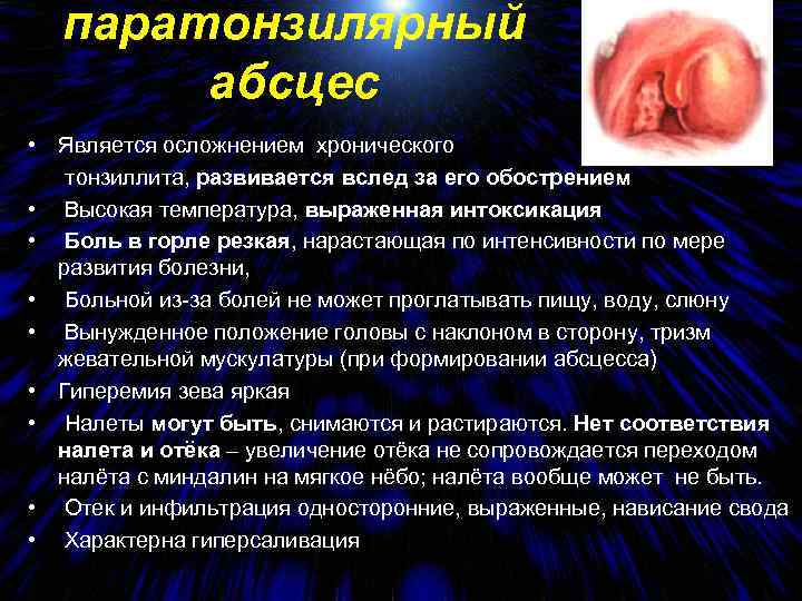 паратонзилярный абсцес • Является осложнением хронического тонзиллита, развивается вслед за его обострением • Высокая