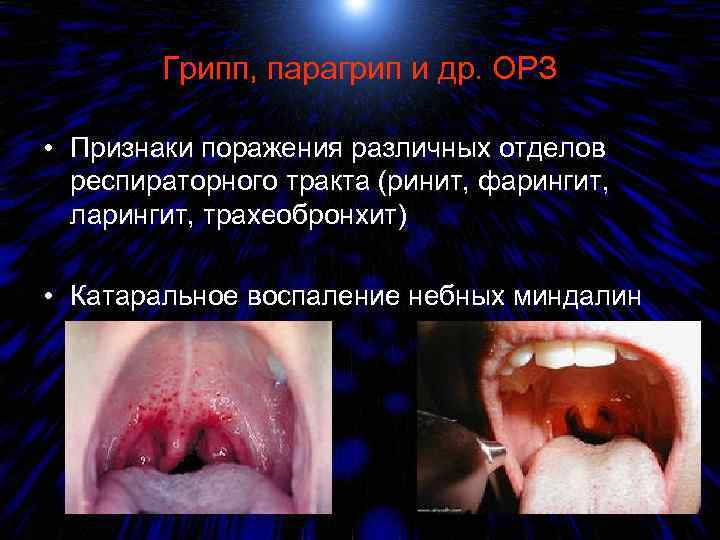 Грипп, парагрип и др. ОРЗ • Признаки поражения различных отделов респираторного тракта (ринит, фарингит,