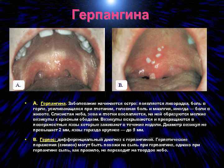 Герпангина А. В. • А. Герпангина. Заболевание начинается остро: появляется лихорадка, боль в горле,