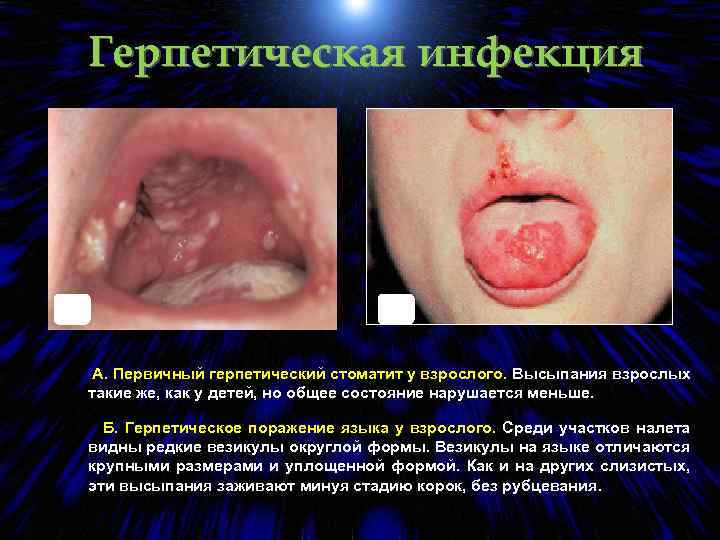 Герпетическая инфекция А. Б. А. Первичный герпетический стоматит у взрослого. Высыпания взрослых такие же,