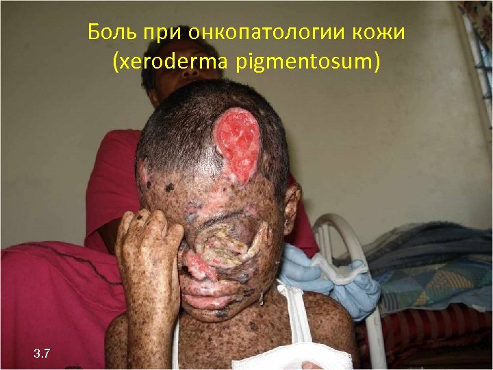 Боль при онкопатологии кожи (xeroderma pigmentosum) 3. 7 
