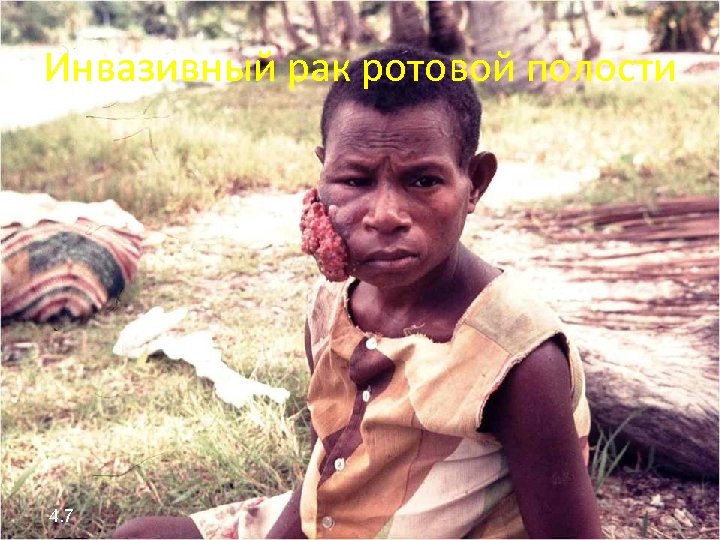 Инвазивный рак ротовой полости 4. 7 