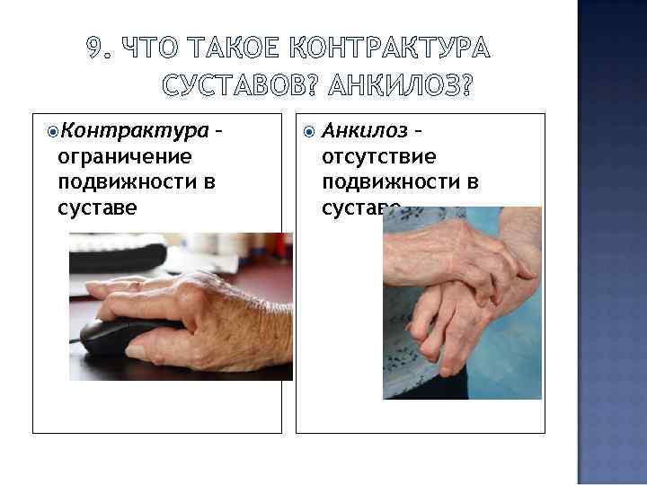 9. ЧТО ТАКОЕ КОНТРАКТУРА СУСТАВОВ? АНКИЛОЗ? Контрактура – ограничение подвижности в суставе Анкилоз –
