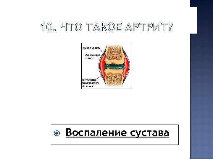 10. ЧТО ТАКОЕ АРТРИТ? Воспаление сустава 