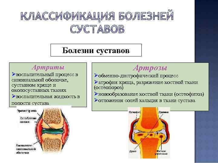 Болезни суставов Артриты Øвоспалительный процесс в синовиальной оболочке, суставном хряще и околосуставных тканях Øвоспалительная