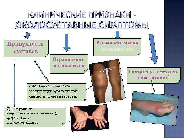 Регидность мышц (скованность) Припухлость суставов Ограничение подвижности Гиперемия и местное повышение tº • воспалительный